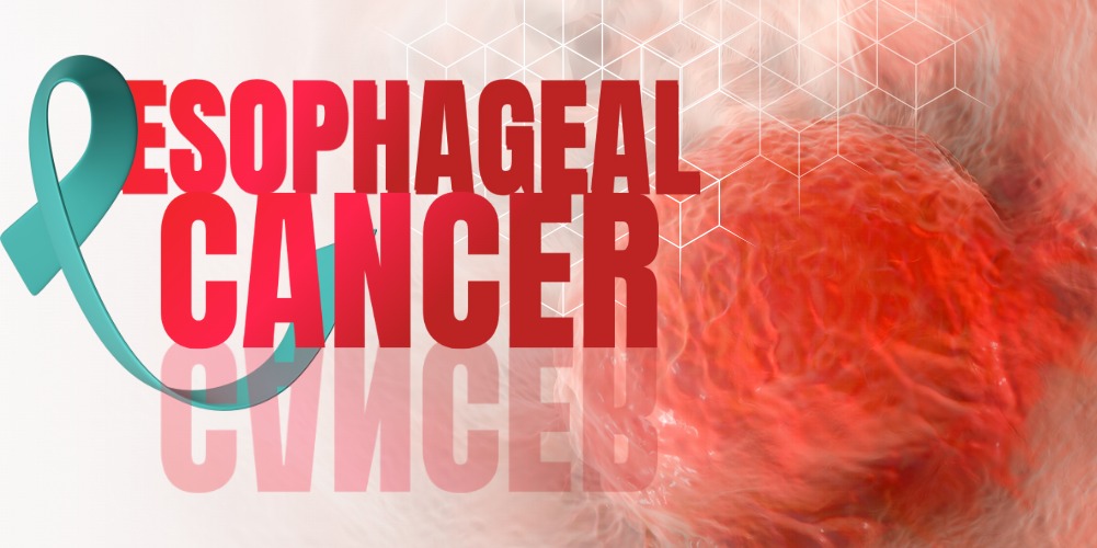 Esophageal Cancer: Types, Symptoms, Causes, Diagnosis & Treatment
