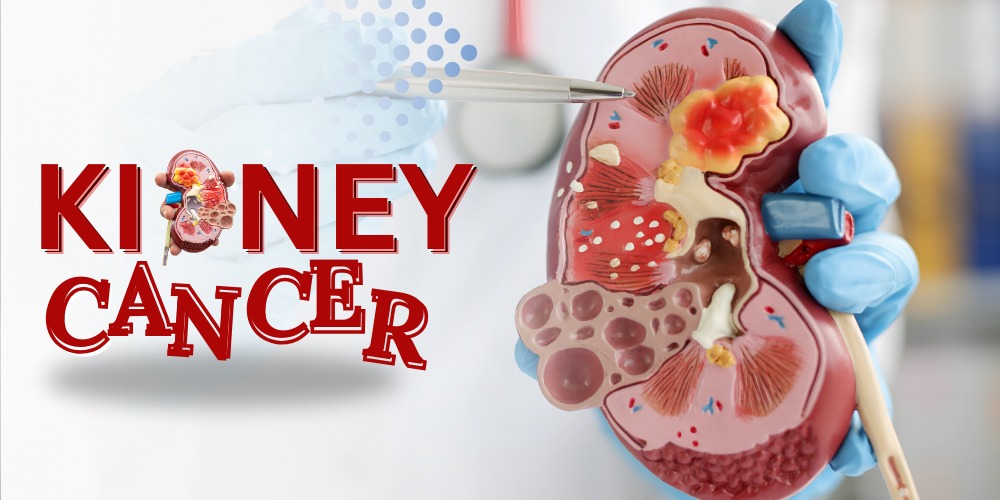 Kidney Cancer: Symptoms, Causes, Types, Diagnosis & Treatment