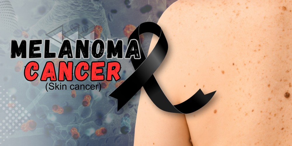 Melanoma Cancer: Types, Symptoms, Causes & Treatment Options | Comprehensive Guide